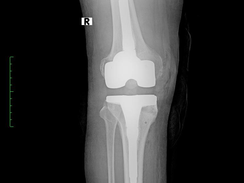 É possível trocar a prótese no futuro?