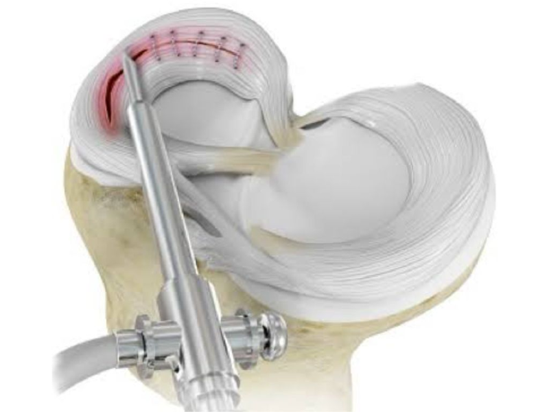 Sutura Meniscal