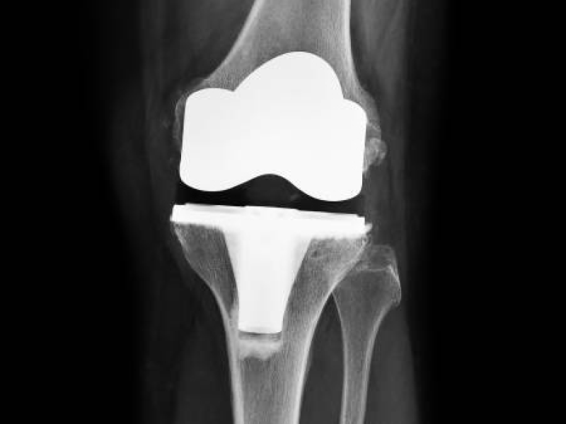 Artroplastia de Joelho (Prótese de Joelho)