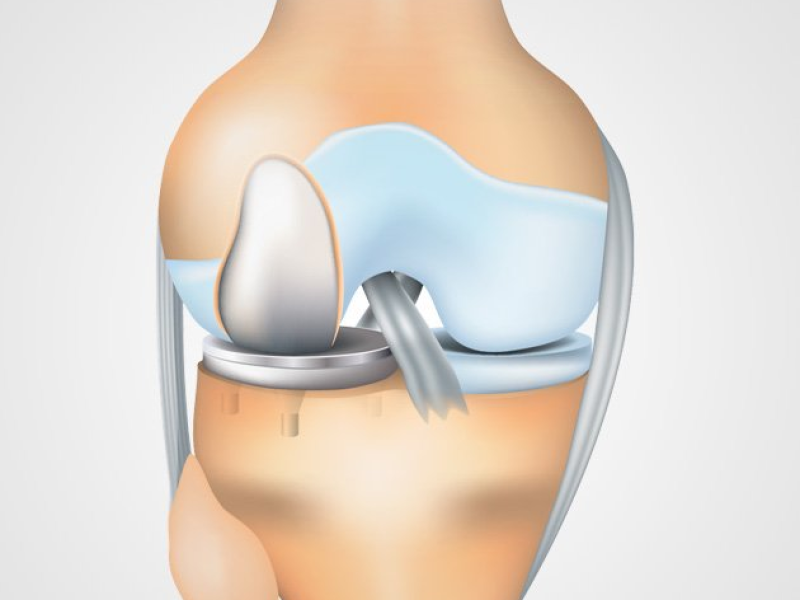 Artroplastia Unicompartimental